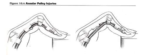 injury-a2-finger-anatomy-3