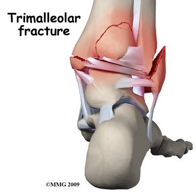 Trimalleolar-Fracture